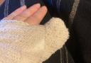 Julia's bandaged hand after receiving treatment.